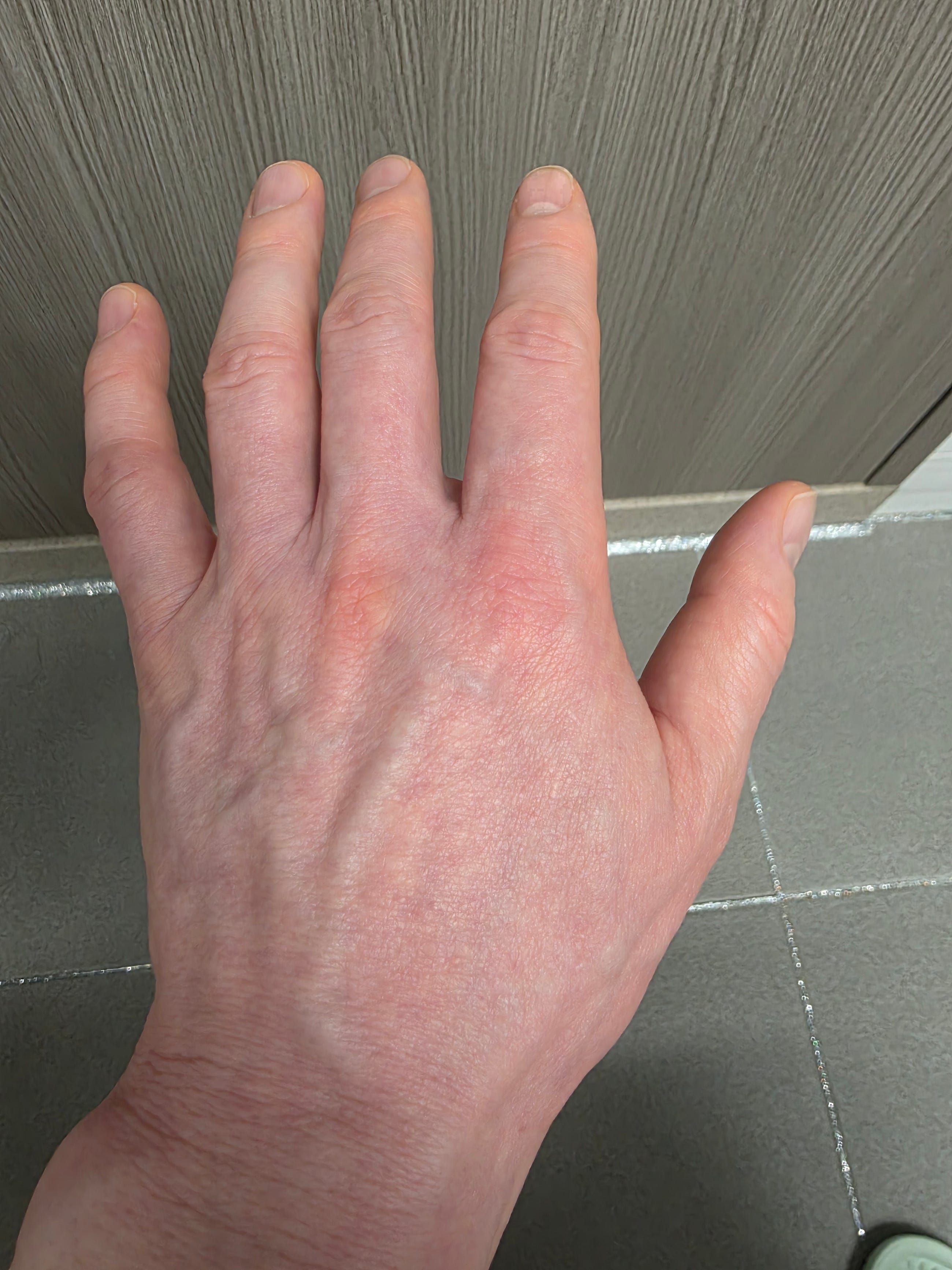 What 4,300 Days Taught Me About Vitiligo That Photos Never Could (Part 2)