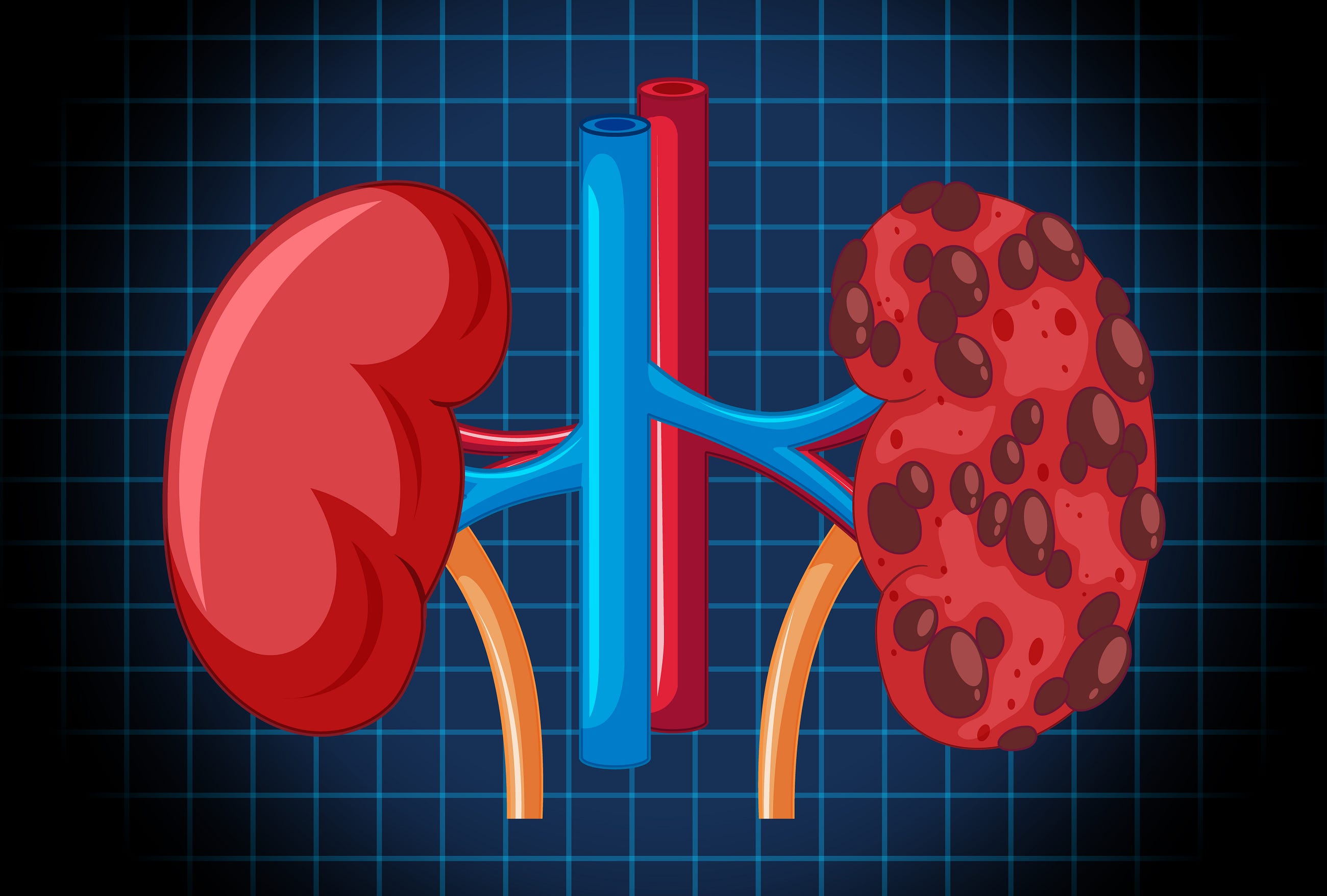 Predicting Chronic Kidney Disease with Machine Learning and Streamlit