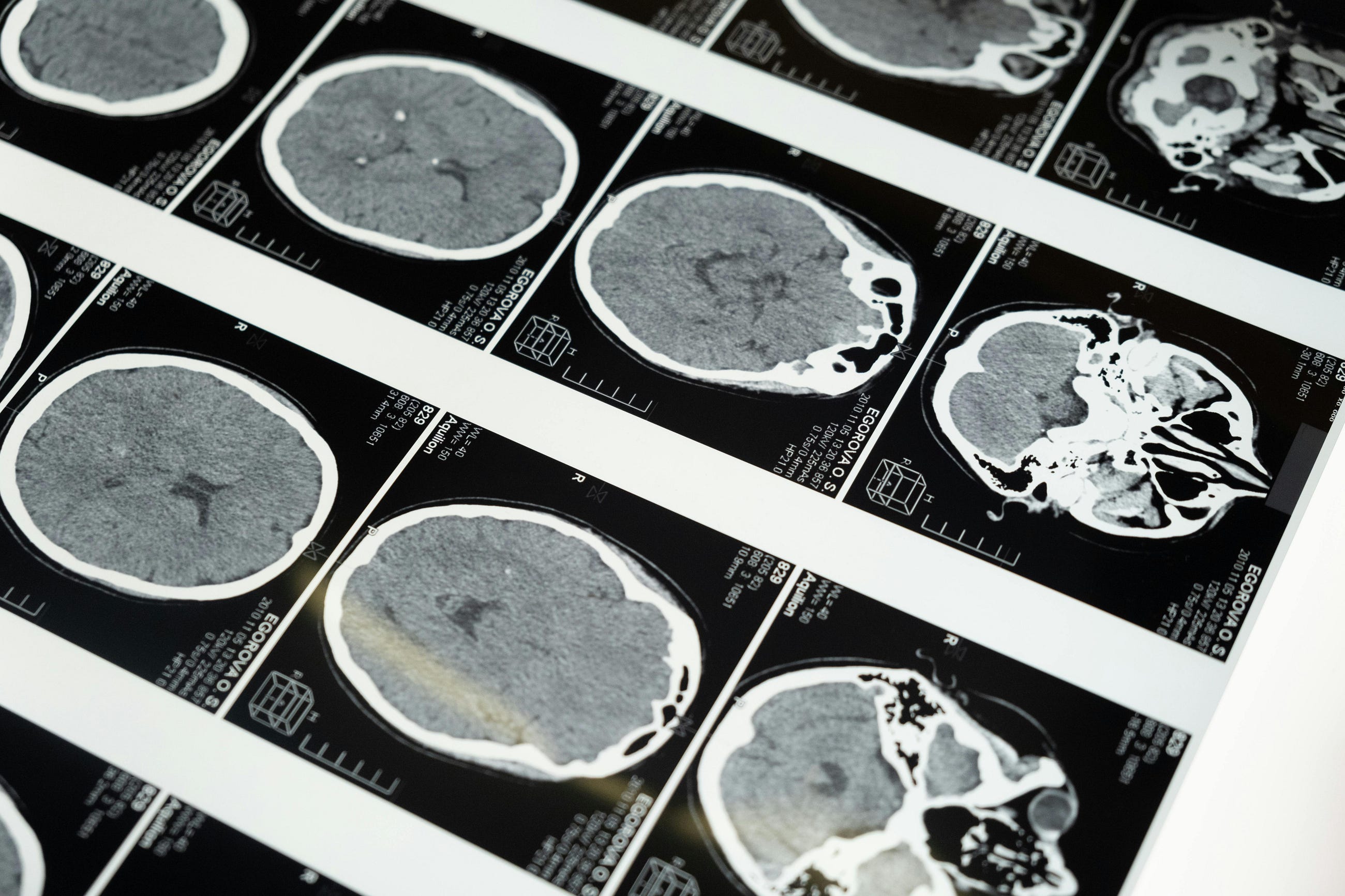 Using AI to Detect Any Brain Disease in MRI Images