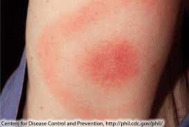 lyme disease image from google images