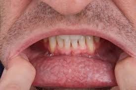 Best Doctor for mouth cancer in delhi at fortis South Delhi, Vasant Kunj