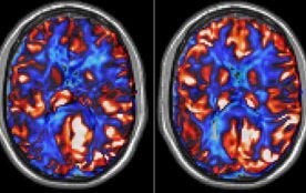 brain blood flow