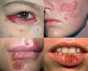 Cara Menyembuhkan Penyakit Herpes Di Wajah Obat Penyakit Herpes