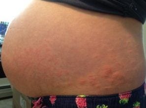 Pengobatan Penyakit Herpes Pada Ibu Hamil Obat Penyakit Herpes