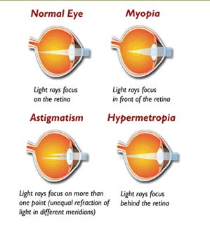 4 images showing how refraction works in an eye with correct vision, myopia (nearsightedness), astigmatism, and hypermetropia (farsightedness).
