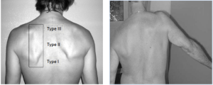 What Your Shoulder Blades are telling you Bang Fitness