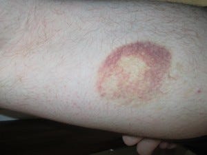 mysterious bruise