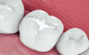 This image is about white fillings vs amalgam fillings: which one is better?
