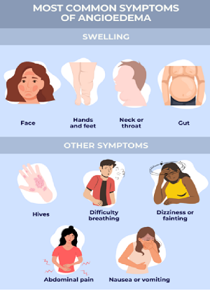 Hives and Angioedema symptoms