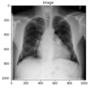 An X-ray of patients chest