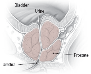 Prostate Problems in Men: Essential Prevention Tips