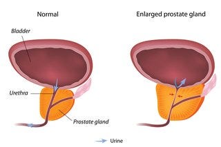Enlarged Prostate Causes: Key Triggers Unveiled