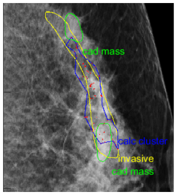 Computer-Aided Detection or CAD software delineates breast masses, calcifications, and calcification clusters. The radiologist delineation of an invasive breast lesion is superimposed over CAD findings