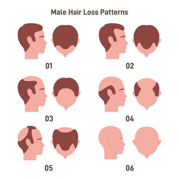 Baldness Pattern, Backlinksvikas, Elation Hair skin clinic Kolkata