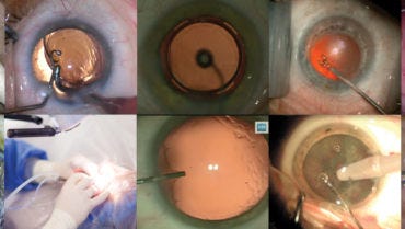 cataract surgery