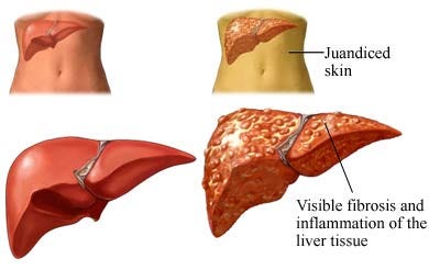 Obat Hepatitis Atau Liver Manjur Dan Aman Dikonsumsi