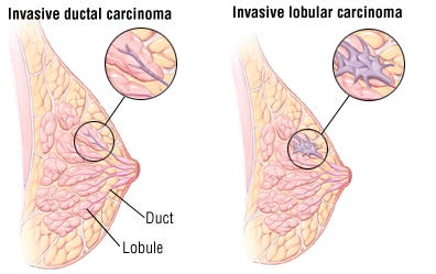 ductile breast cancer Tara reid breast video clip