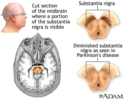 Neurons of the substantia nigra progressively degenerate due to Parkinson’s disease (MedlinePlus, 2024).