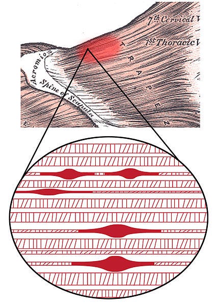 Muscle knots/ trigger points stop blood flow