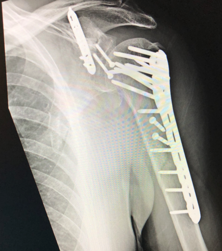 X-ray of repaired broken humerus.