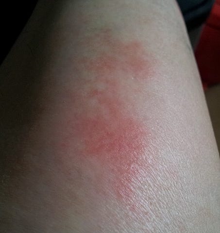 march-or-horse-fly-bites-1