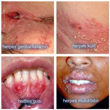 Cara Mengobati Herpes Di Sekitar Mata Obat Penyakit Herpes Bagus