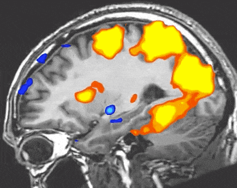 fMRI Brain Scan: Brain regions activated by playing Re-Mission. Red/orange/yellow = increased activity. Blue = decreased activity. https://youtu.be/9IK2eDh3cVs