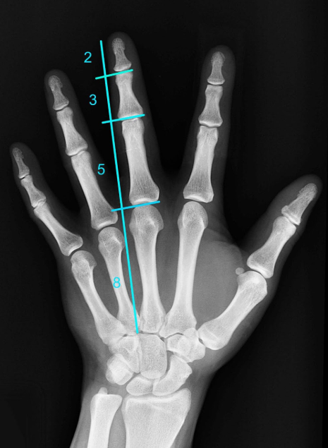 Os o tamanho dos ossos dos nossos dedos — as falanges — se enquadram na sequência de Fibonacci. Incrível, né?