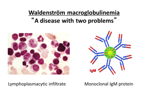 what is waldenstrom macroglobulinemia