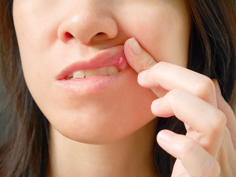 mouth ulcer in kids