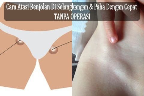 Cara Menghilangkan Sekelan Di Selangkangan atau Ketiak Tanpa Operasi