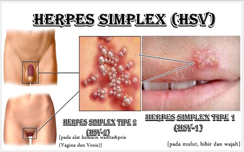 Cara Mengobati Herpes Kelamin Secara Tradisional Obat Penyakit