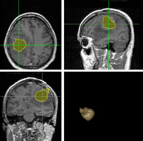 Automated segmentation of Brain Tumors