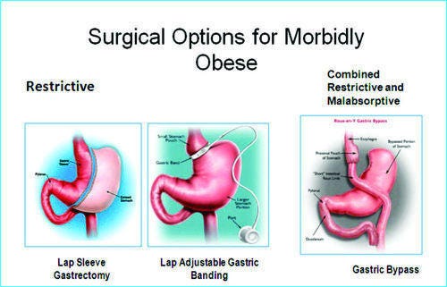 best bariatric surgery in pune