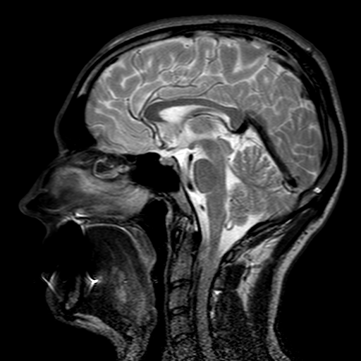 An MRI of a human head — photo courtesy of Wikimedia Commons and Mikael Voss — https://commons.wikimedia.org/wiki/File:Head_MRI,_enlarged_inferior_sagittal_sinus.png