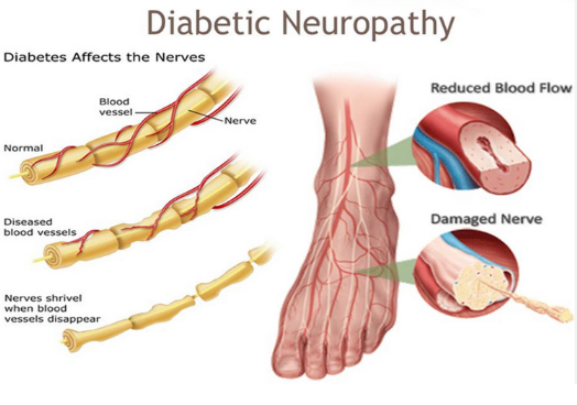 Diabetic Neuropathy Treatment