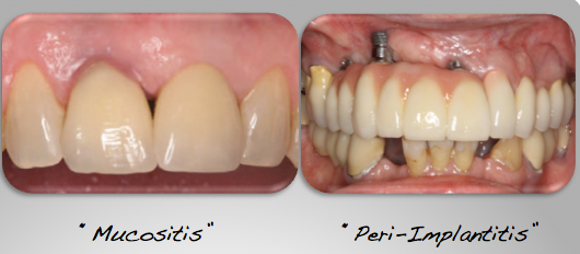 Peri-Implantitis Bukan Peri Biasa- Global Estetik Dental Care
