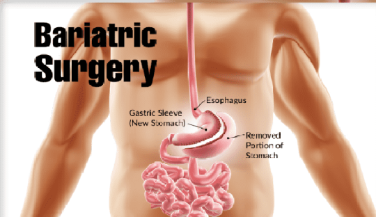 Bariatric Surgery In Pune And Mumbai