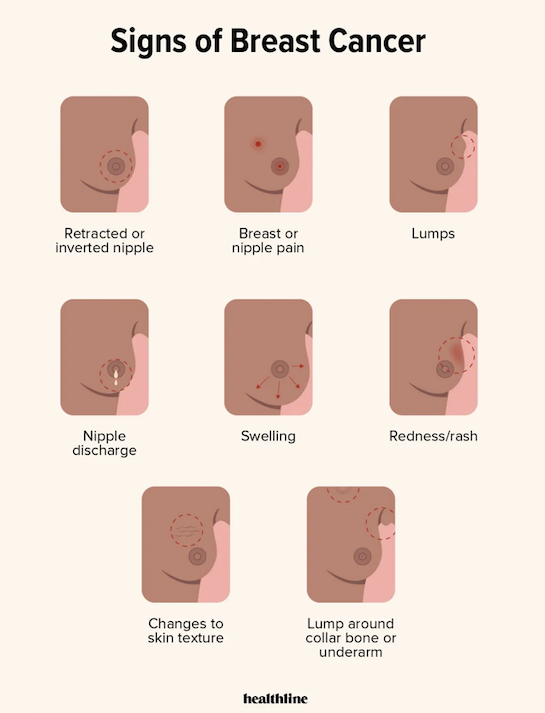 Signs of Breast Cancer