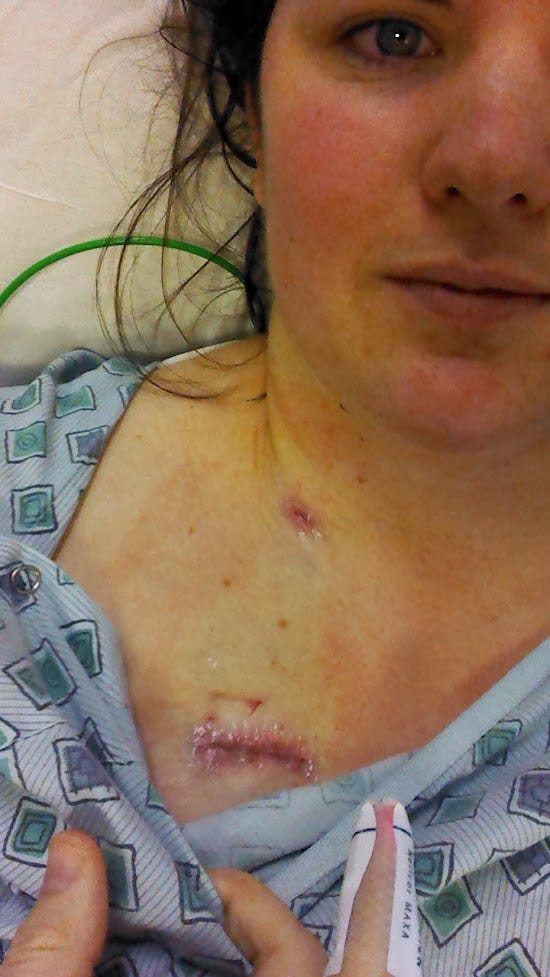 Photo of author, Jessica Reed, with the incision sites visible for the placement of a medi-port.