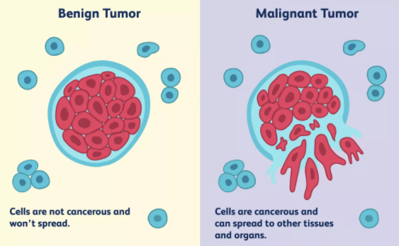 Difference between Benign tumor and Malignant tumor