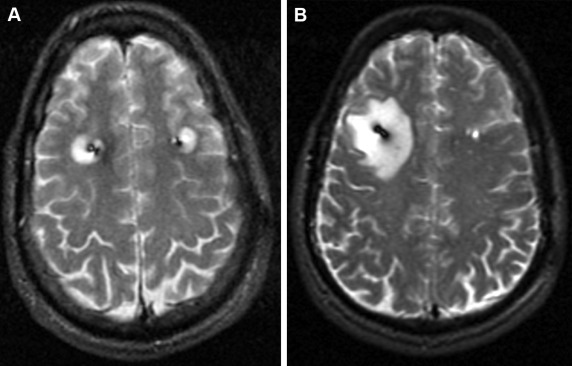 Cerebral Edema post DBS surgery (Whiting et al., 2019).