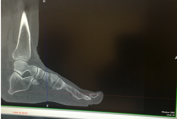 X-ray of the author’s dislocated big toe.