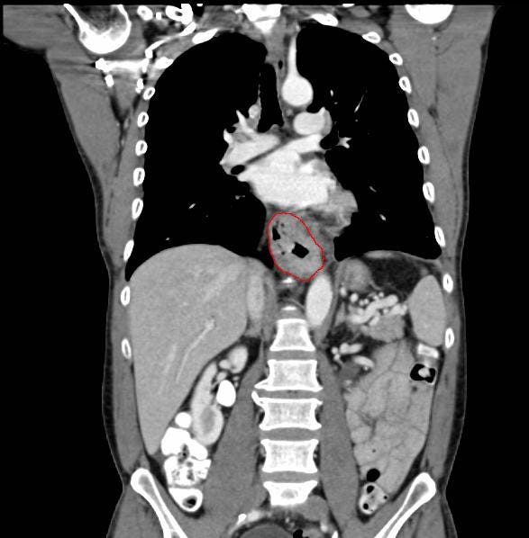 Esophageal cancer, CT scan with contrast, coronal image