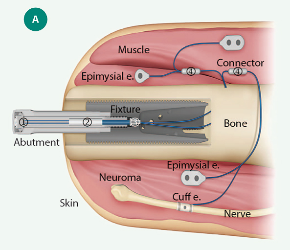 A detailed model showing the integration of electrodes and the titanium screw into the residual limb.