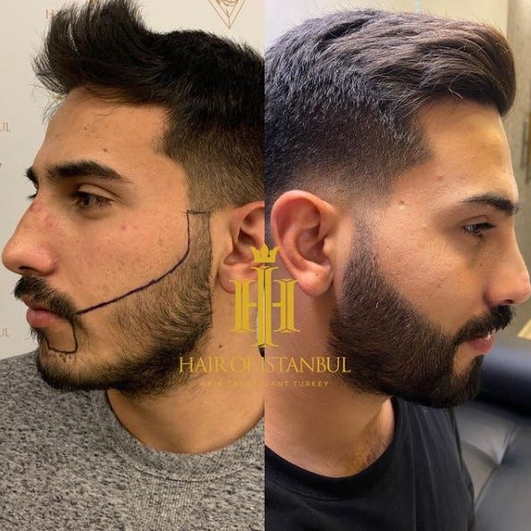 before-and-after-scar-treatment-hair-of-istanbul