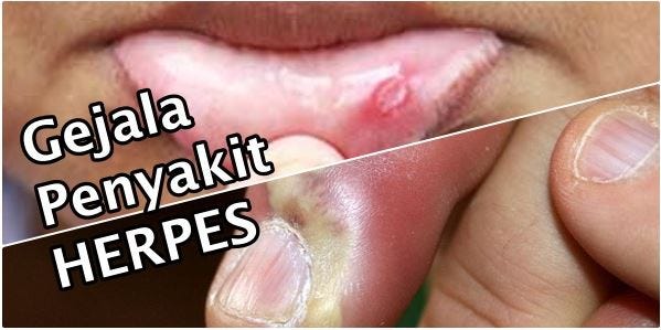 herpes menular melalui apa saja