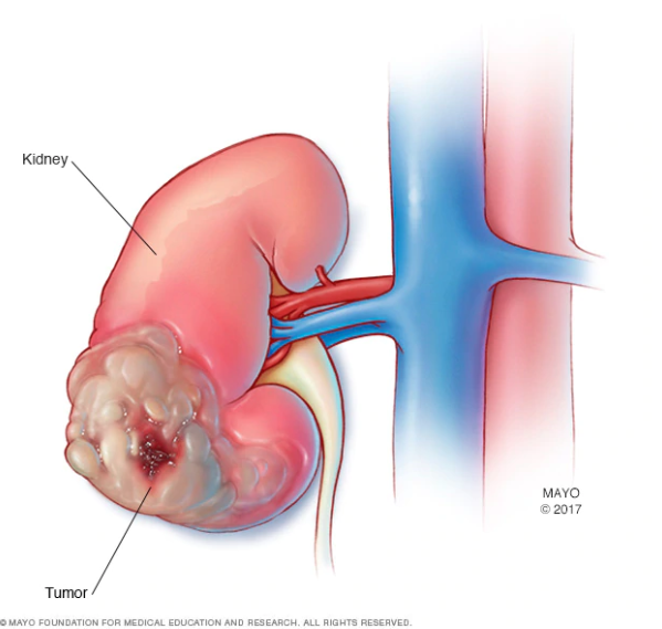 What is a Kidney Cancer?