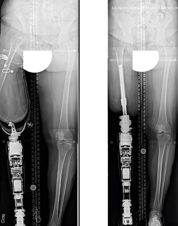 X-ray images showing the bad alignment between the residual limb with a socket-based prosthesis (left) and an aligned osseointegrated leg implant and connected prosthesis (right)