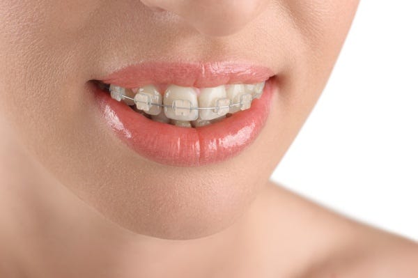 Braces or Aligners Treatment in Mohali — 32 Sparklets | Dentist In Mohali | Best Dentist in Mohali